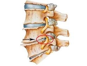 Príznaky a príznaky osteochondrózy