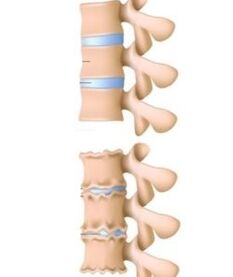 Príčiny osteochondrózy