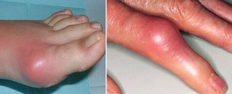 vzhľad kĺbov s artritídou