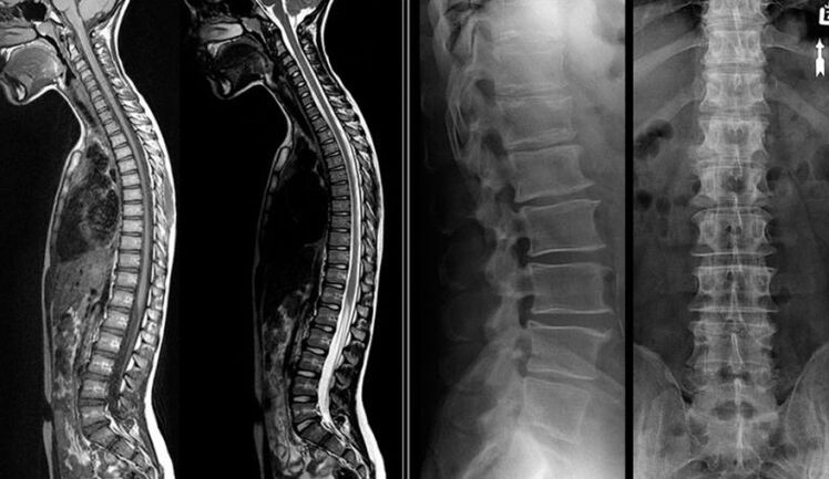 RTG a MRI obrázky na osteochondrózu