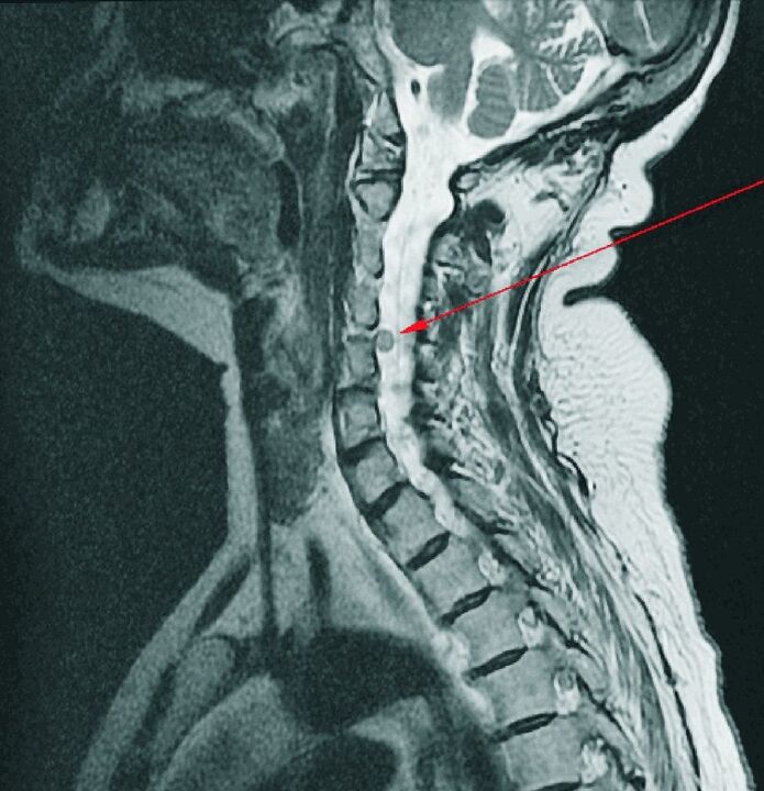 Intervertebrálna hernia krčnej chrbtice na MRI