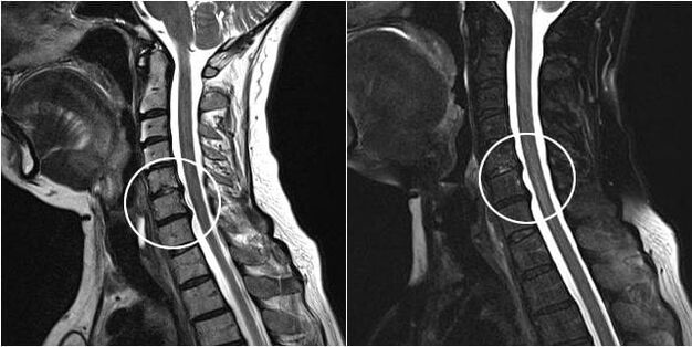 MRI krčnej chrbtice s príznakmi osteochondrózy