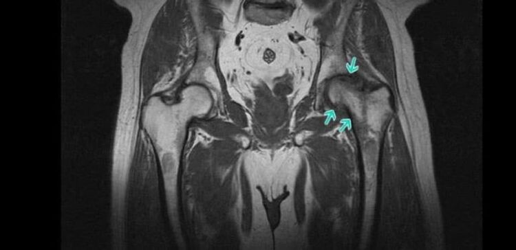 Degeneratívne-dystrofické zmeny v bedrovom kĺbe na MRI