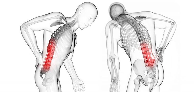 komplikácie s cervikálnou osteochondrózou